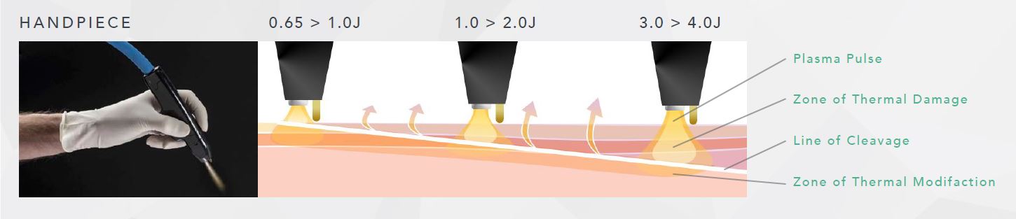 The NEOGEN™ EVO Handpiece - Click to zoom in The NEOGEN™ EVO Handpiece - Click to zoom in