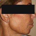 2 - Hifu Face lift Treatment after