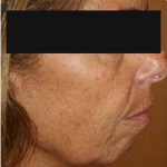 2 - Hifu Face lift Treatment Before