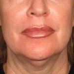 5- Hifu Face lift Treatment before