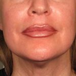 5- Hifu Face lift Treatment After