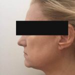 4 - Hifu Face lift Treatment After