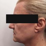 4 - Hifu Face lift Treatment before