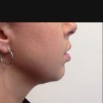 3 - Hifu Face lift Treatment after