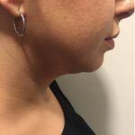 3 - Hifu Face lift Treatment before