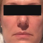 1 - Hifu Face lift Treatment After