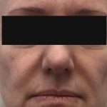 1 - Hifu Face lift Treatment before