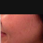 6- Hifu Face lift Treatment After