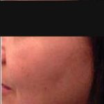 6- Hifu Face lift Treatment Before